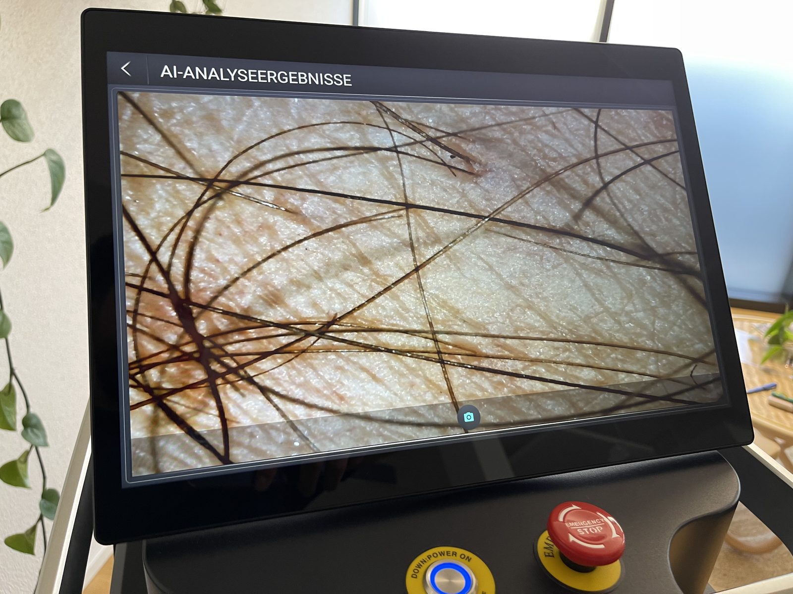 KI-Analyse von Haardichte und Follikeln am Touchscreen des VisioSkin Pro Laser